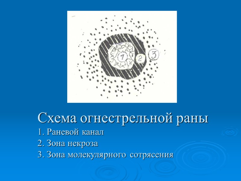 Схема огнестрельной раны 1. Раневой канал 2. Зона некроза 3. Зона молекулярного сотрясения